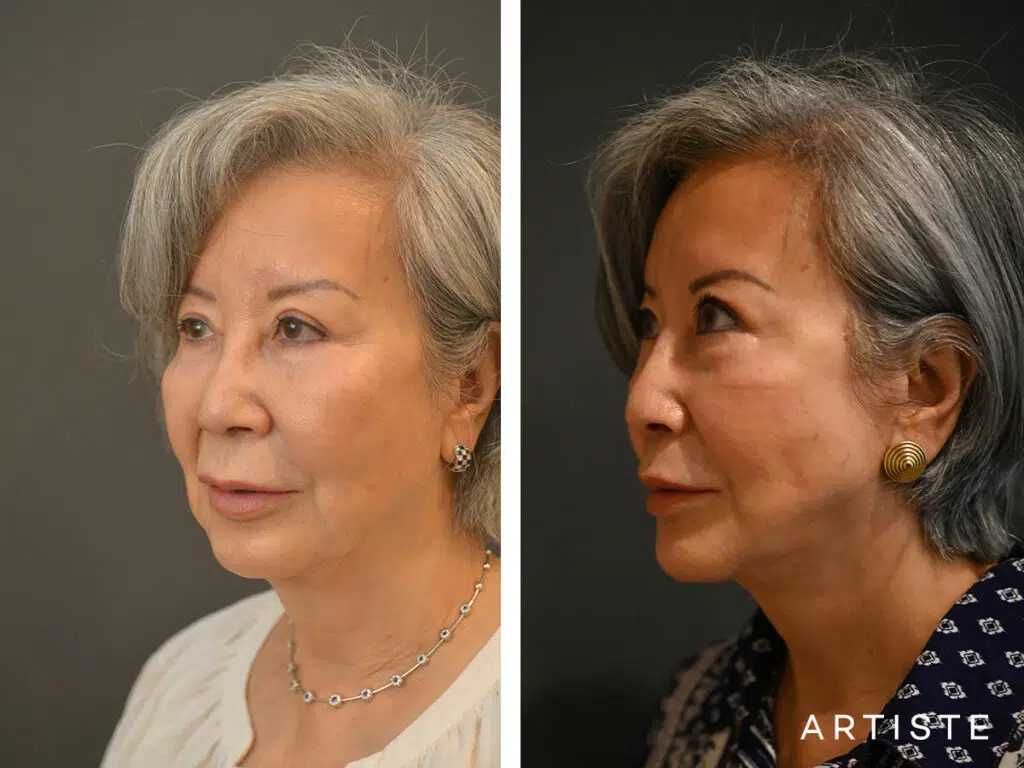 76 Years Old: Deep Plane Facelift and Lip Lift