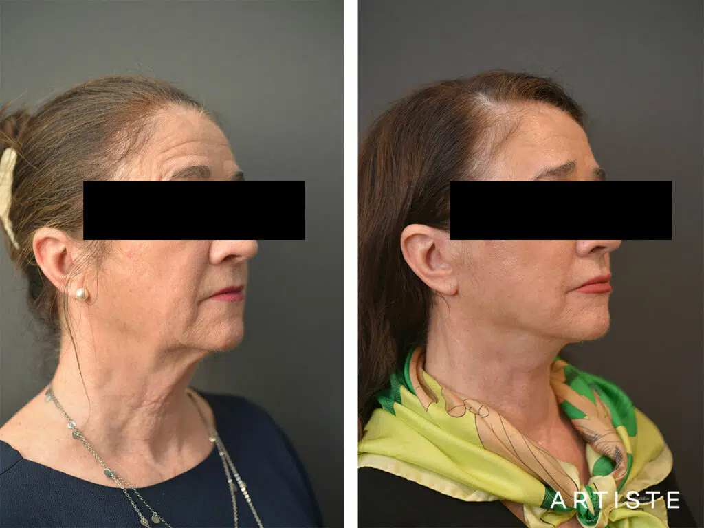 64 Years Old: High SMAS Face and Neck Lift, Micro Fat Grafting and Upper Eyelid Blepharoplasty