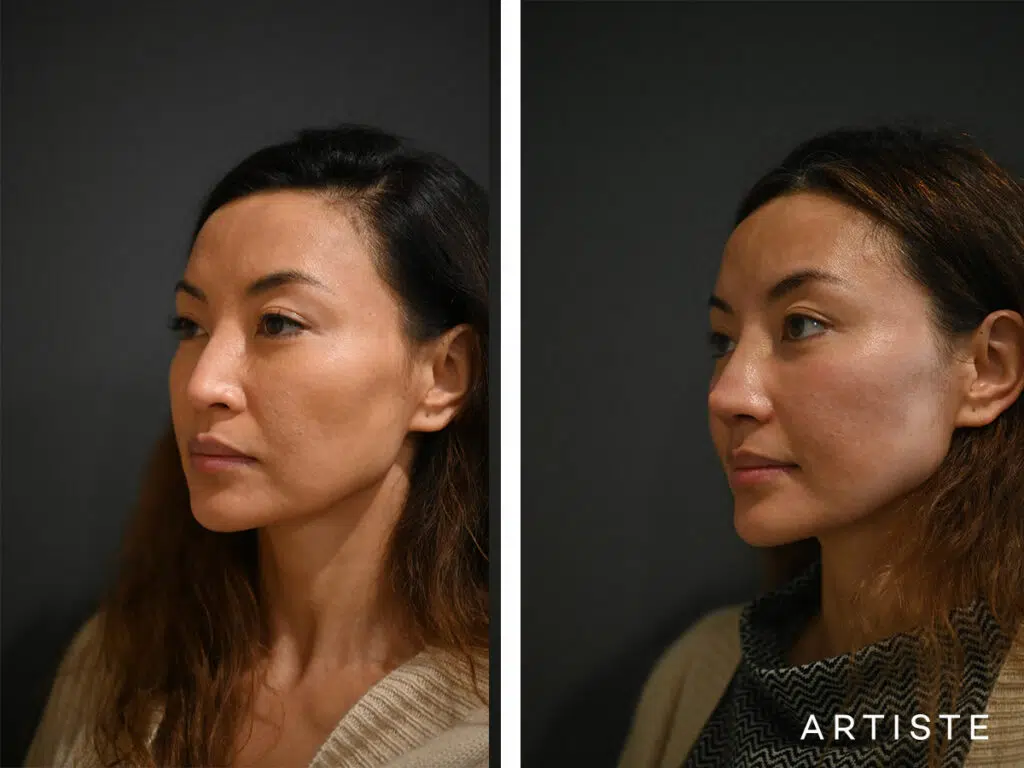 39 Years Old: Allograft Nose Augmentation