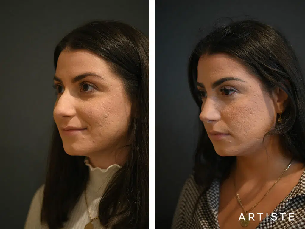 27 Years Old: Open Sturcture Rhinoplasty