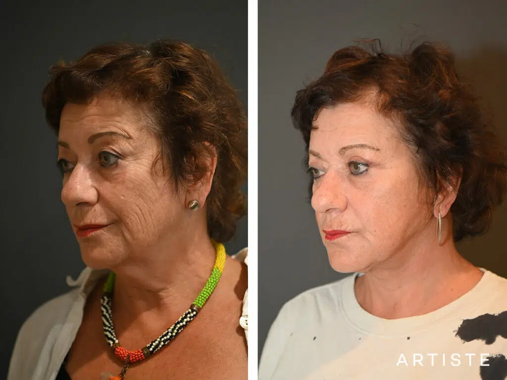 64 Years Old: Deep Plane Neck Lift