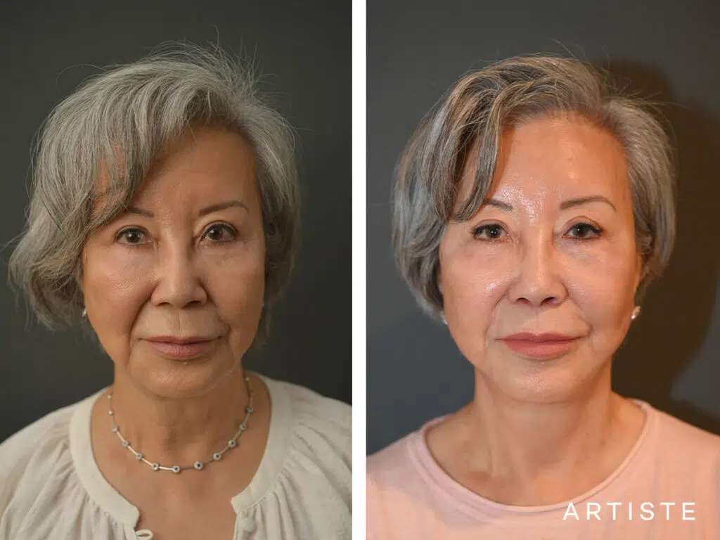 76 Years Old: Deep Plane Facelift and Lip Lift