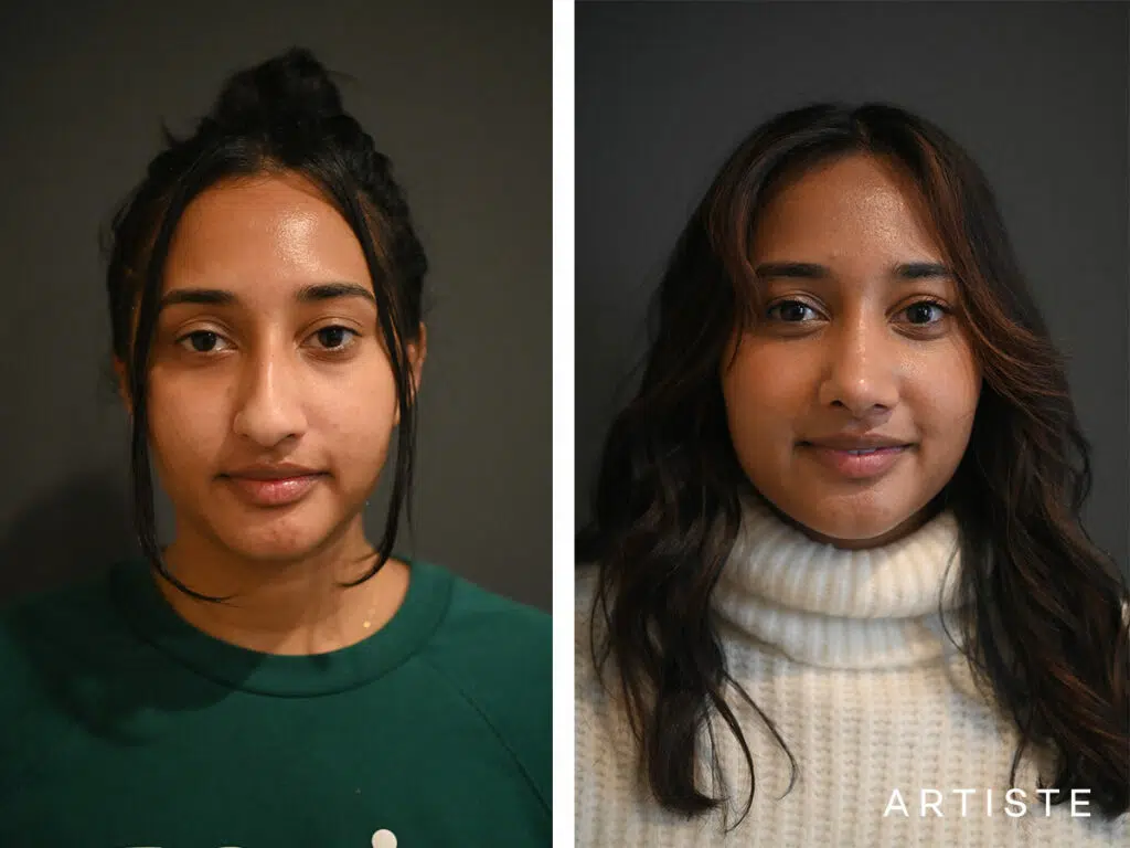 26 Years Old: Ethnic Open Structure Rhinoplasty