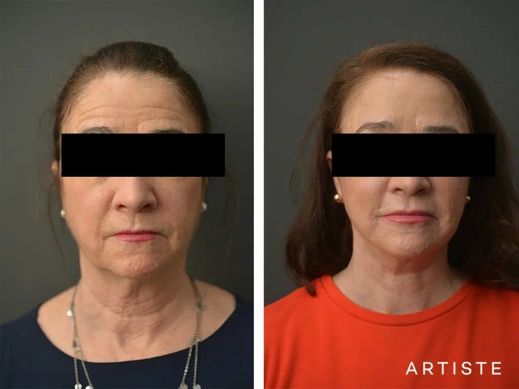 64 Years Old: High SMAS Face and Neck Lift, Micro Fat Grafting and Upper Eyelid Blepharoplasty