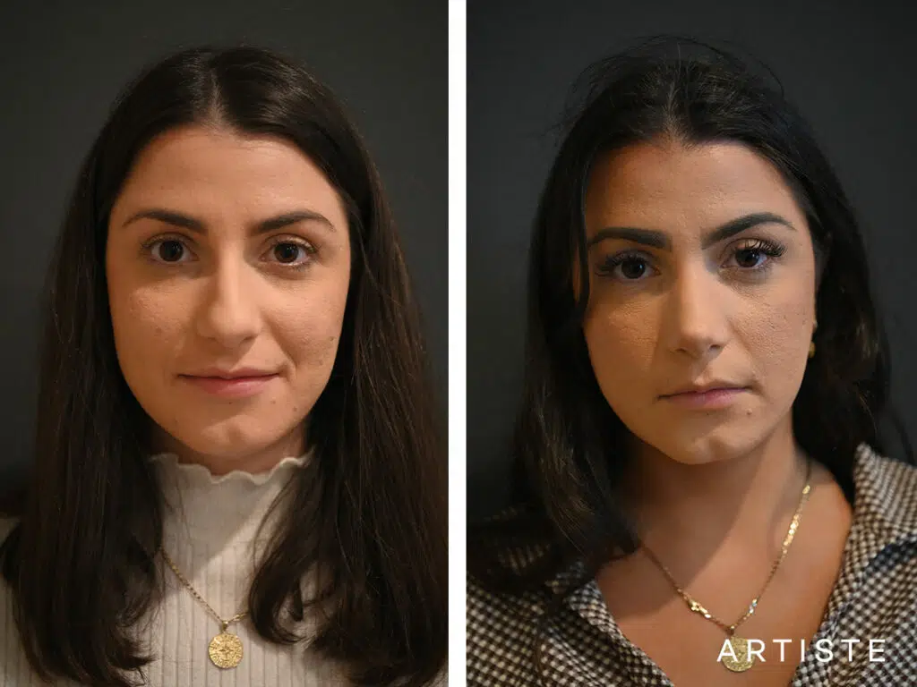 27 Years Old: Open Sturcture Rhinoplasty