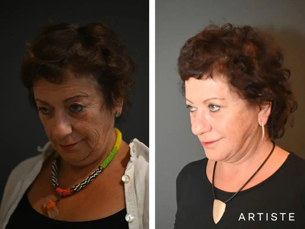 64 Years Old: Deep Plane Neck Lift