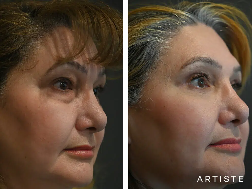 60 Years Old: Lower Eyelid Blepharoplasty