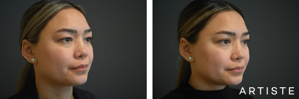 41 Years Old: Upper Eyelid Blepharoplasty
