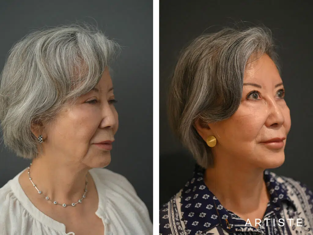 76 Years Old: Deep Plane Facelift and Lip Lift