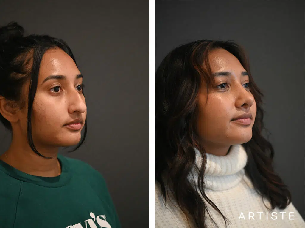 26 Years Old: Ethnic Open Structure Rhinoplasty