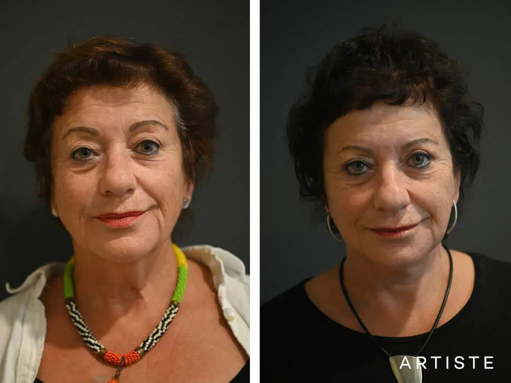 64 Years Old: Deep Plane Neck Lift