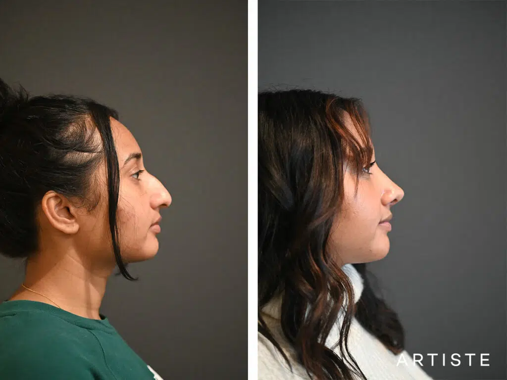 26 Years Old: Ethnic Open Structure Rhinoplasty