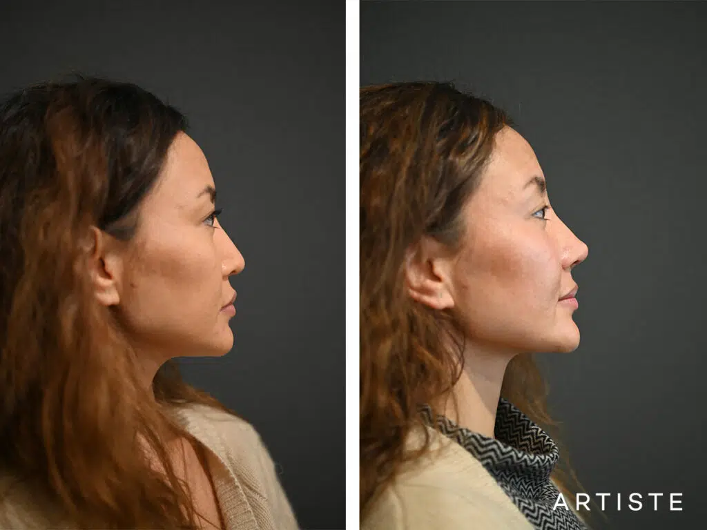 39 Years Old: Allograft Nose Augmentation