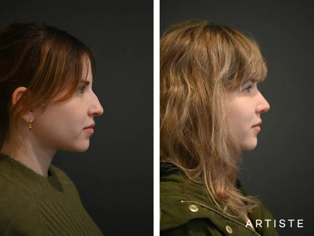 30 Years Old: Post Hybrid Stucture and Preservation Rhinoplasty