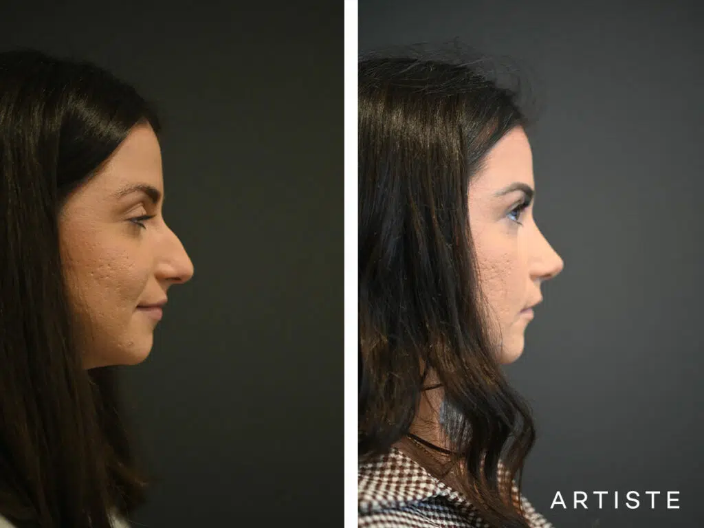 27 Years Old: Open Sturcture Rhinoplasty