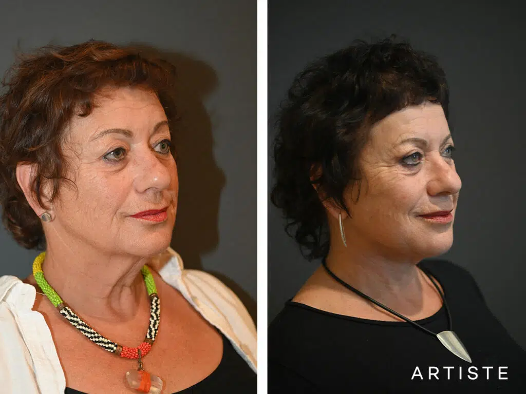 64 Years Old: Deep Plane Neck Lift