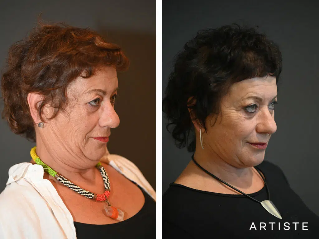 64 Years Old: Deep Plane Neck Lift