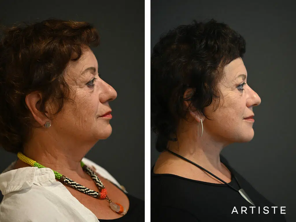 64 Years Old: Deep Plane Neck Lift