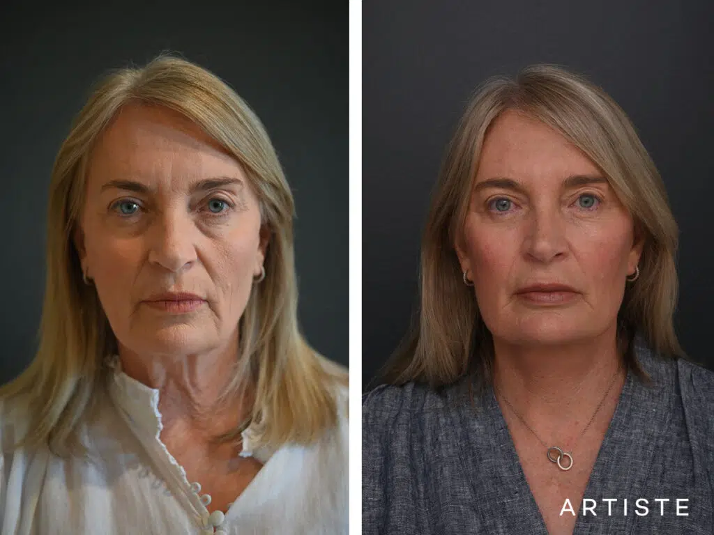 High SMAS Face and Neck Lift, Upper and Lower Eyelid Surgery, Fat transfer 12 months post