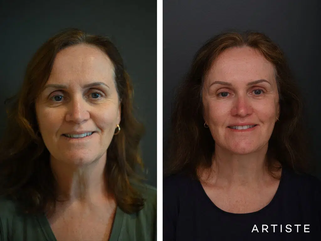 High SMAS Face and Neck Lift, Upper Eyelids, Brow Lift and Lip lift dermabrasion and peel 12 months post