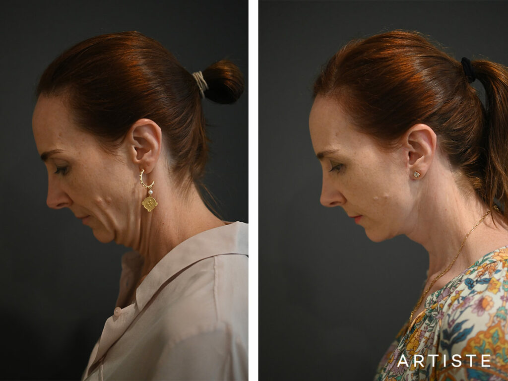 45 Years Old: Deep Plane Neck Lift and Lower Eyelid Blepharoplasty