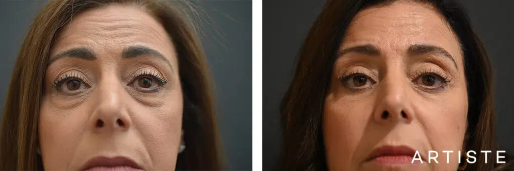 57 Years Old: Lower Eyelid Blepharoplasty