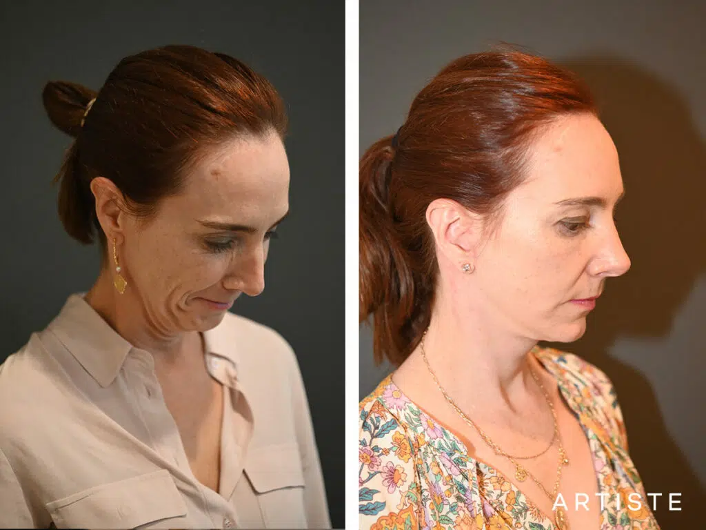 45 Years Old: Deep Plane Neck Lift and Lower Eyelid Blepharoplasty