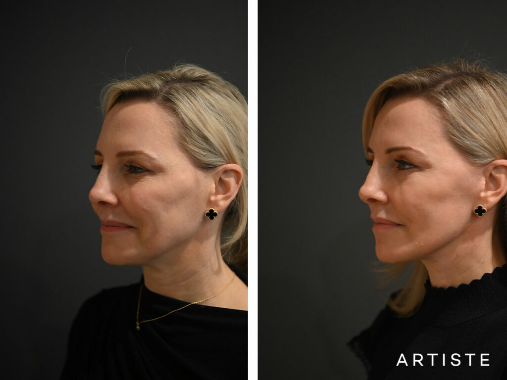 42 Years Old: High SMAS Face and Neck Lift Surgery, Micro Fat Grafting and Lower Eyelid Pinch Blepharoplasty