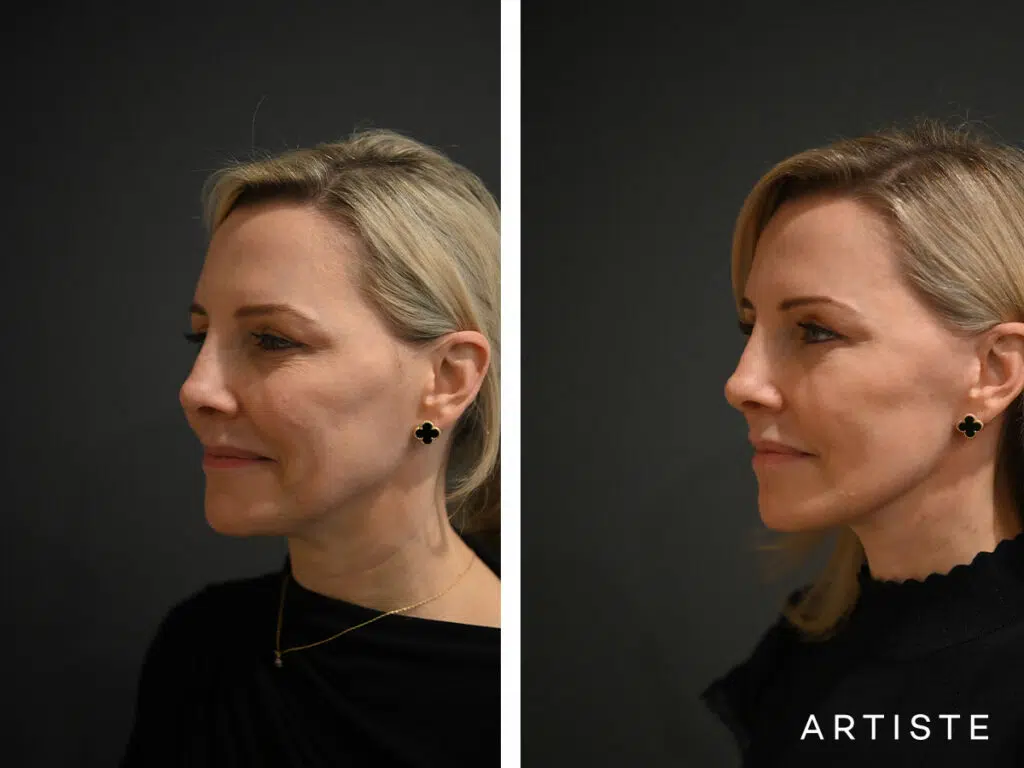 42 Years Old: High SMAS Face and Neck Lift, Micro Fat Grafting and Lower Eyelid Pinch Blepharoplasty