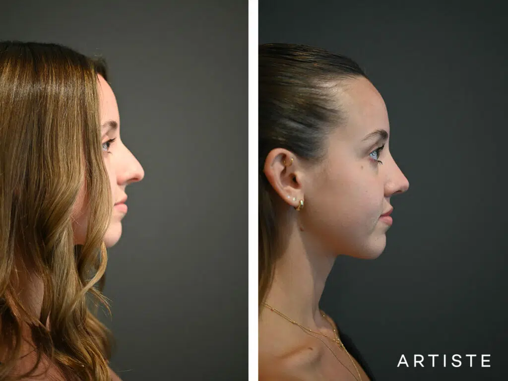 22 Years Old: 9 months Post Open Sturcture Rhinoplasty