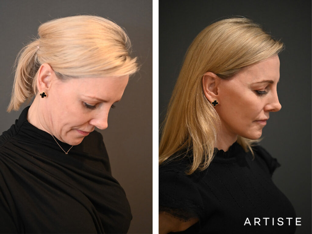42 Years Old: High SMAS Face and Neck Lift Surgery, Micro Fat Grafting and Lower Eyelid Pinch Blepharoplasty