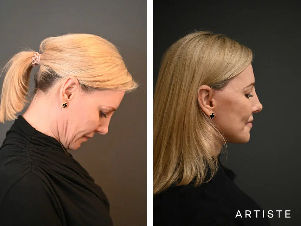 42 Years Old: High SMAS Face and Neck Lift, Micro Fat Grafting and Lower Eyelid Pinch Blepharoplasty