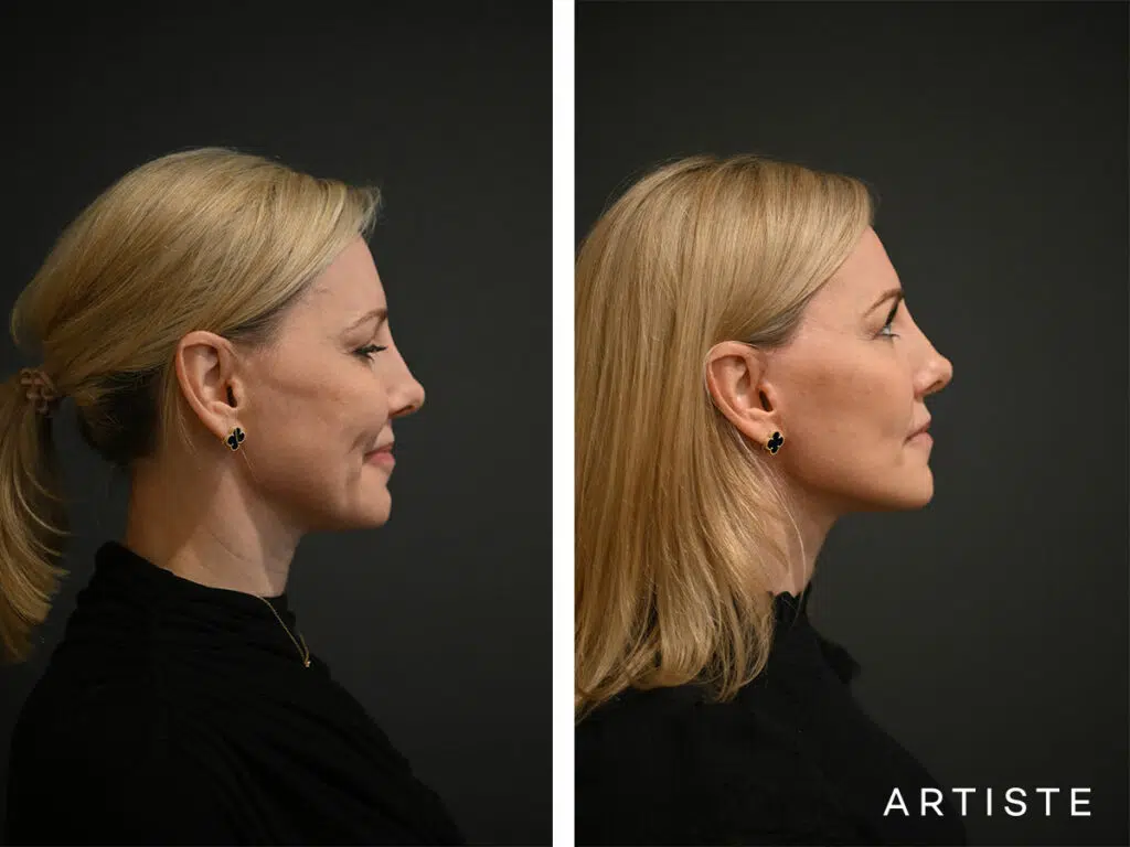 42 Years Old: High SMAS Face and Neck Lift, Micro Fat Grafting and Lower Eyelid Pinch Blepharoplasty