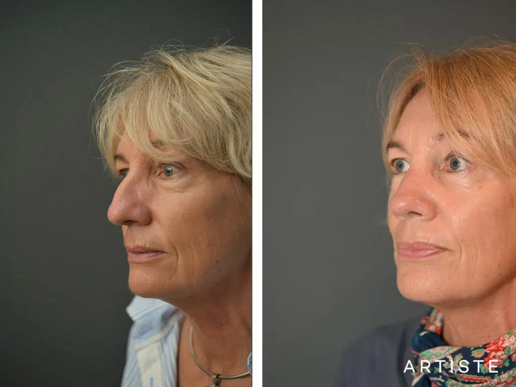 54 Years Old: 6 months Post Open Structure Rhinoplasty