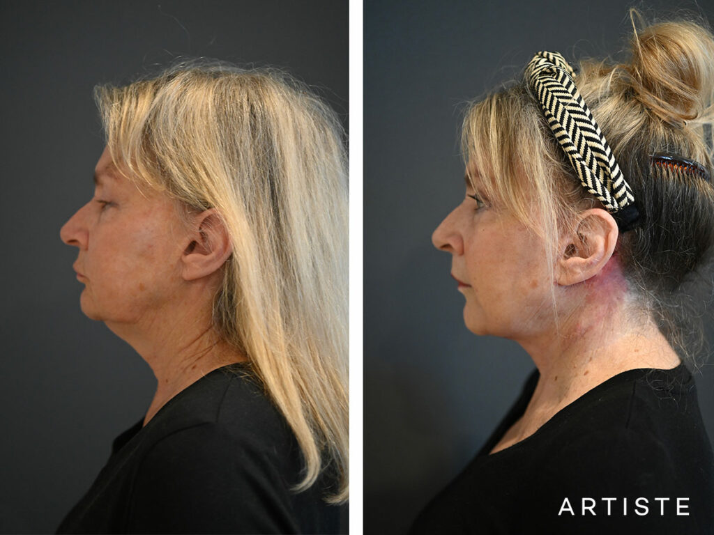 69 Years Old: Deep Plane Face and Neck Lift and Micro Fat Grafting