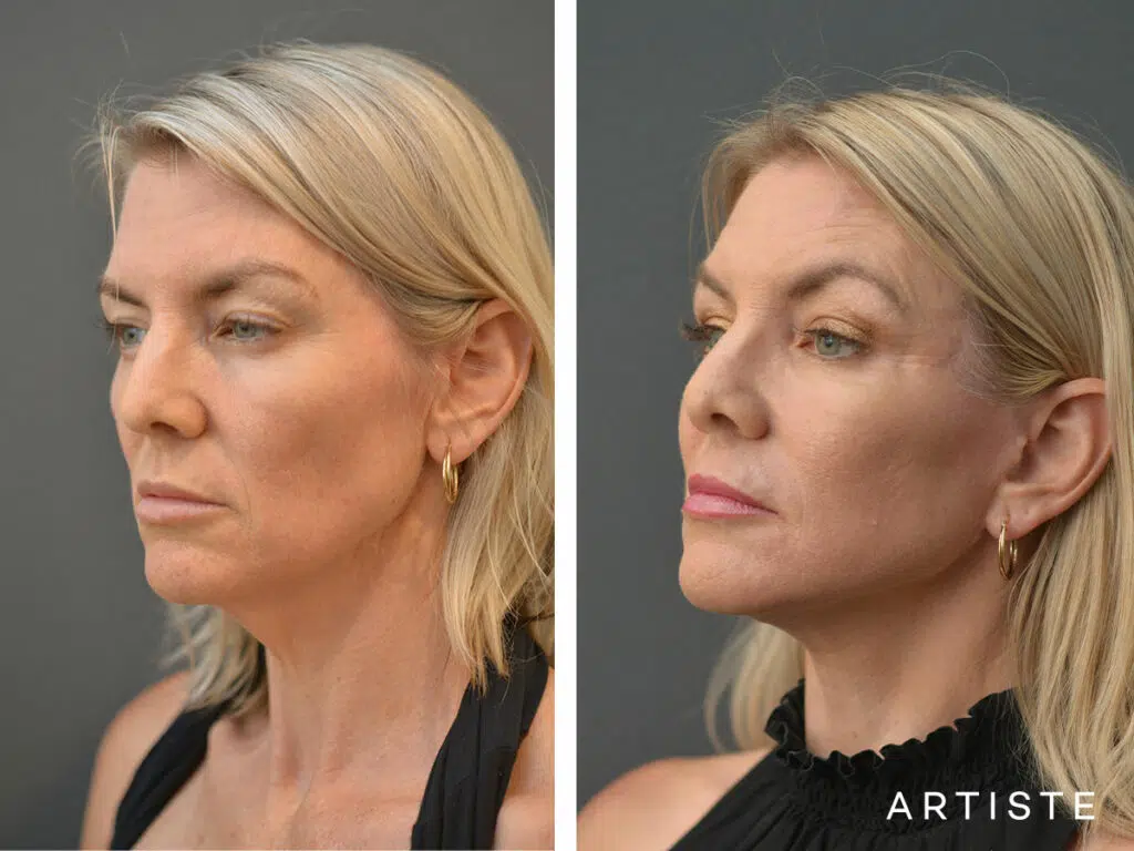 46 Years old: High SMAS Face and Neck Lift, Micro Fat Grafting, Peri-Oral Dermabrasion and Chemical Peel