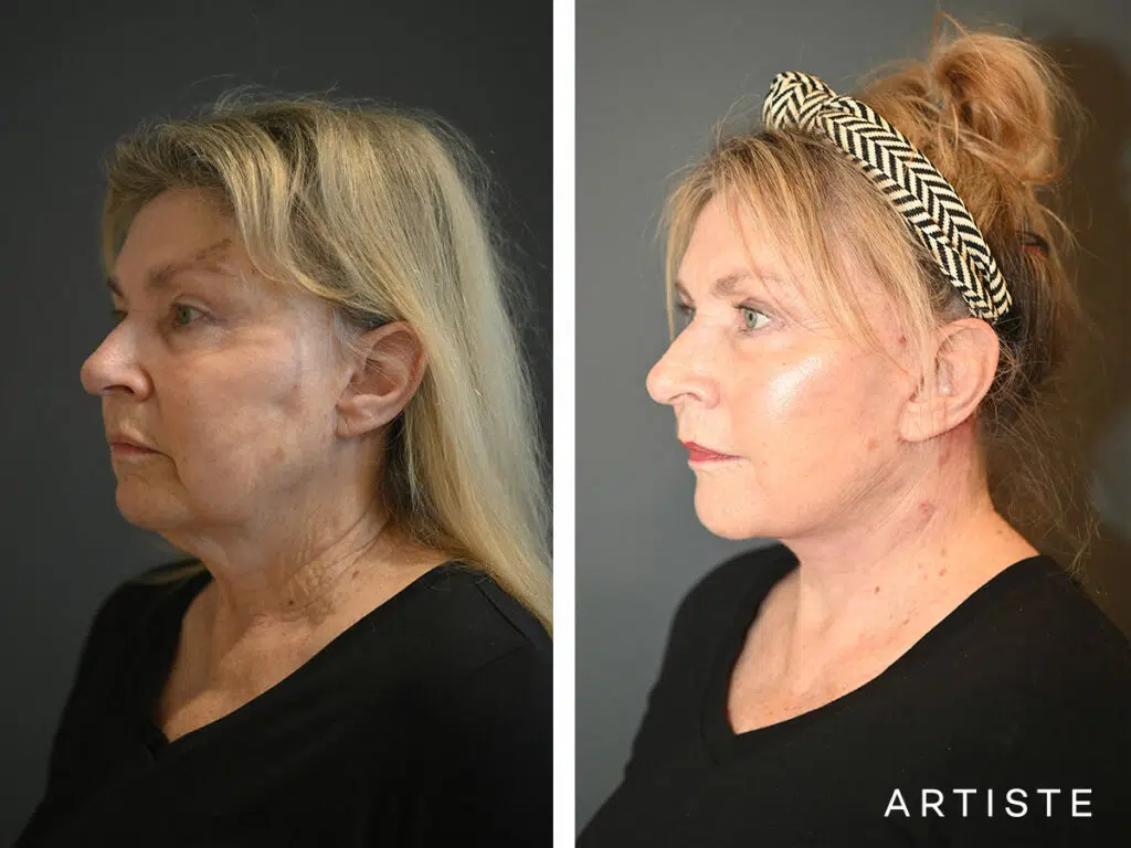 69 Years Old: Deep Plane Face and Neck Lift and Micro Fat Grafting