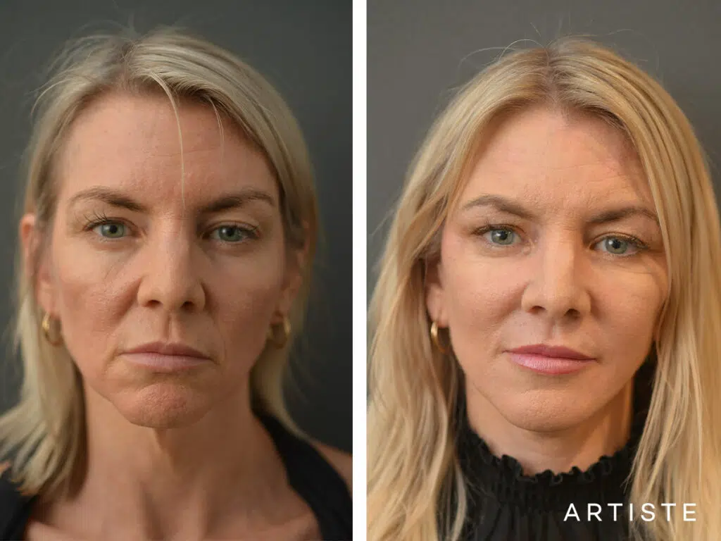 46 Years old: High SMAS Face and Neck Lift, Micro Fat Grafting, Peri-Oral Dermabrasion and Chemical Peel