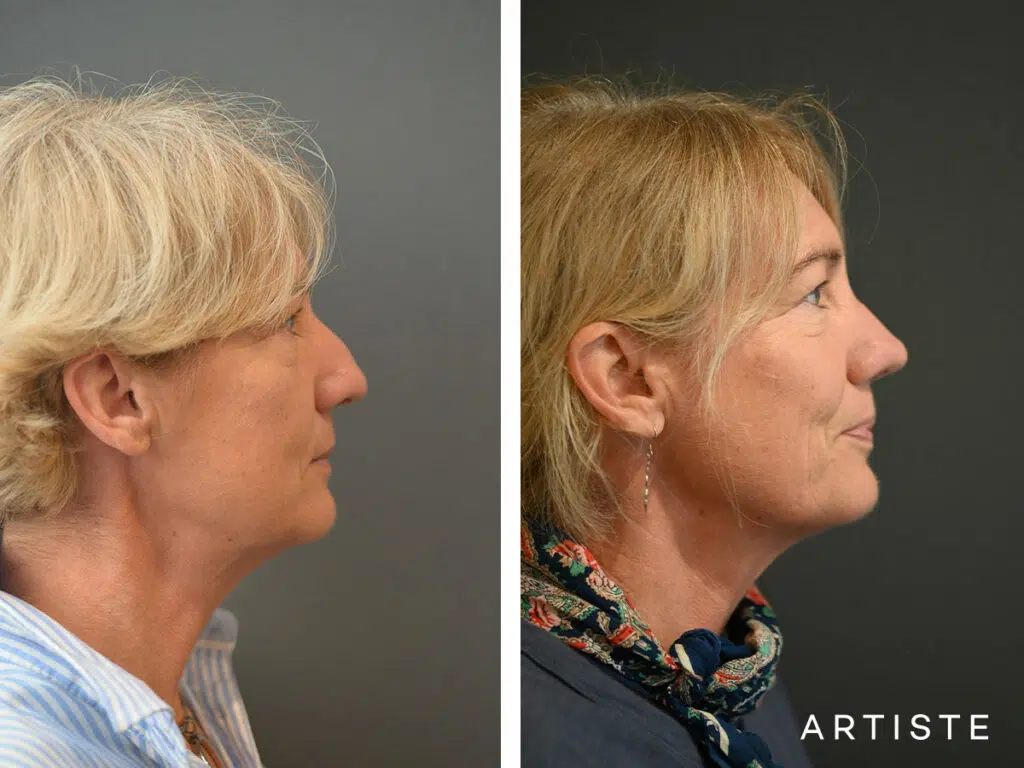 54 Years Old: 6 months Post Open Structure Rhinoplasty