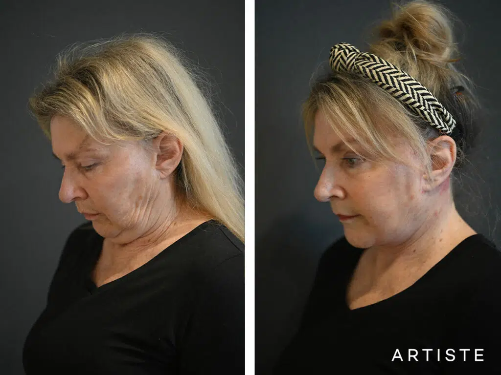 69 Years Old: Deep Plane Face and Neck Lift and Micro Fat Grafting