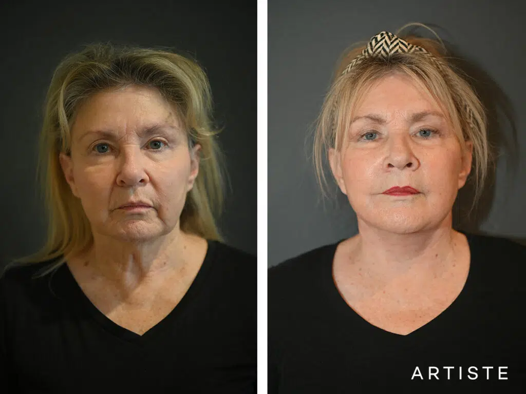 69 Years Old: Deep Plane Face and Neck Lift and Micro Fat Grafting