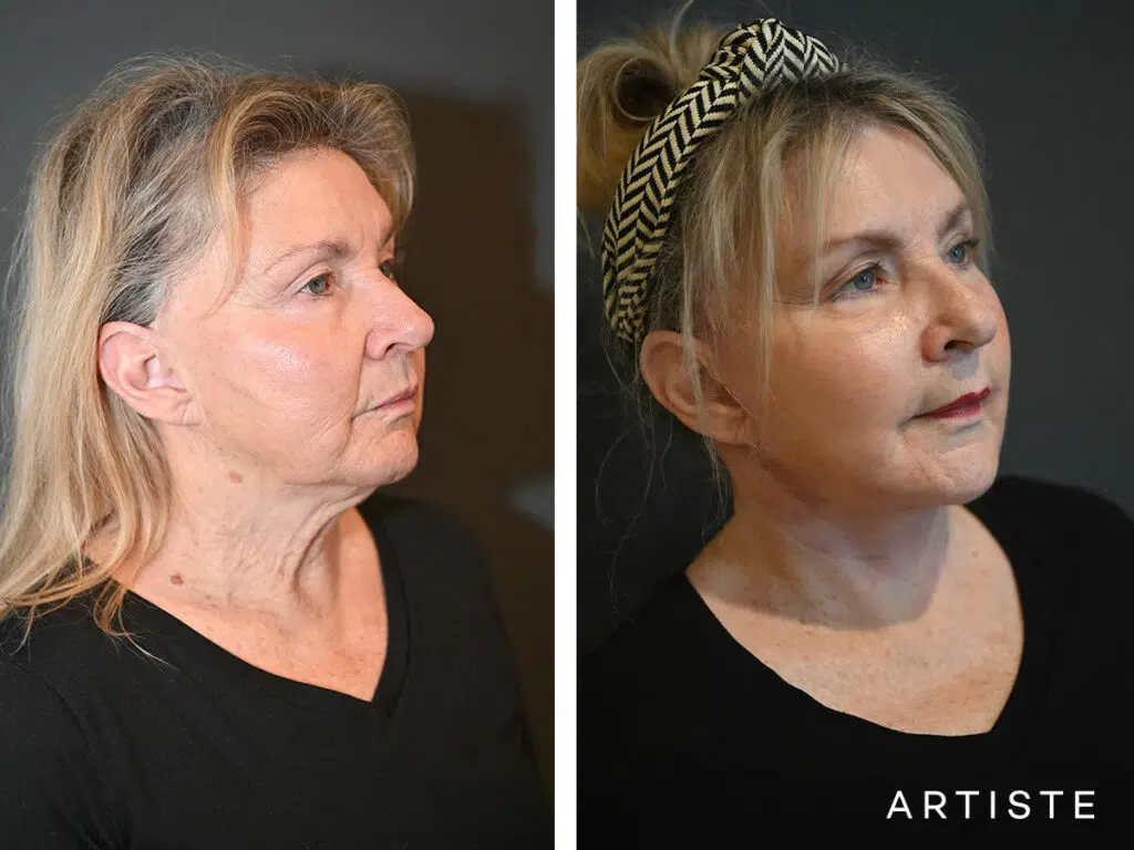 69 Years Old: Deep Plane Face and Neck Lift and Micro Fat Grafting