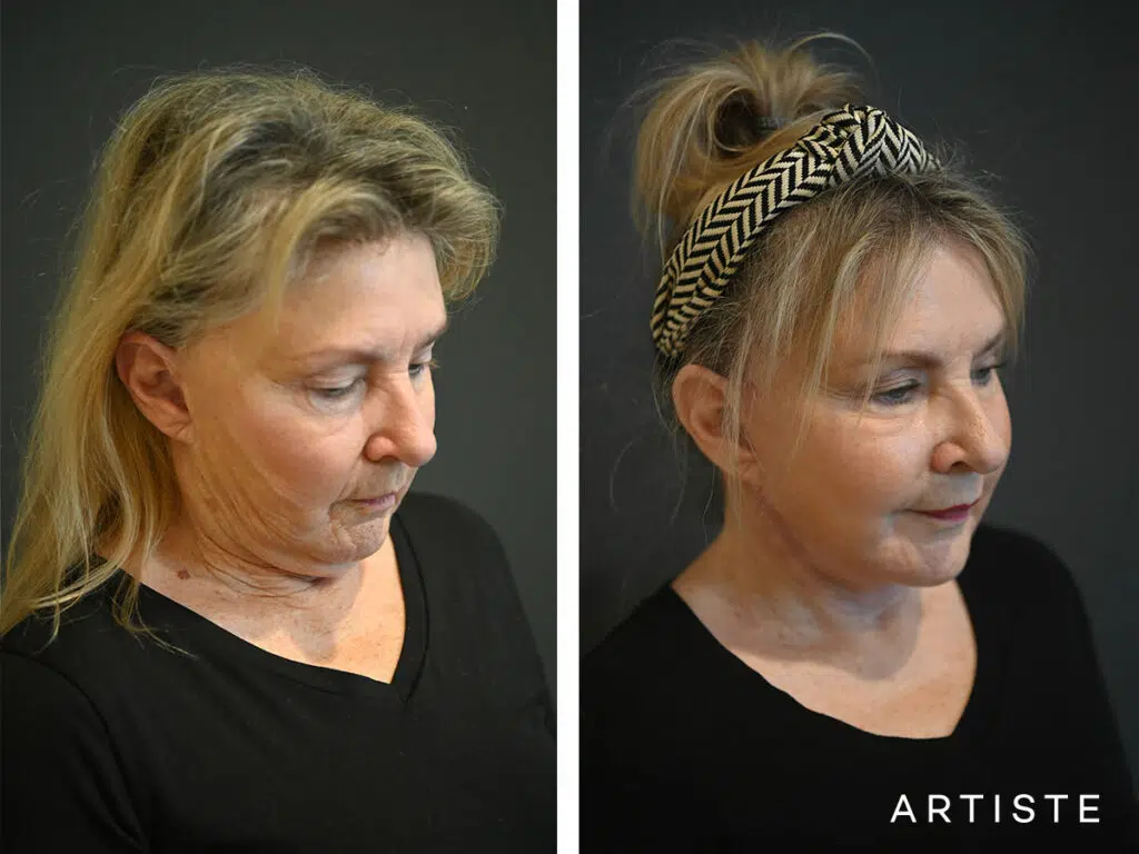 69 Years Old: Deep Plane Face and Neck Lift and Micro Fat Grafting