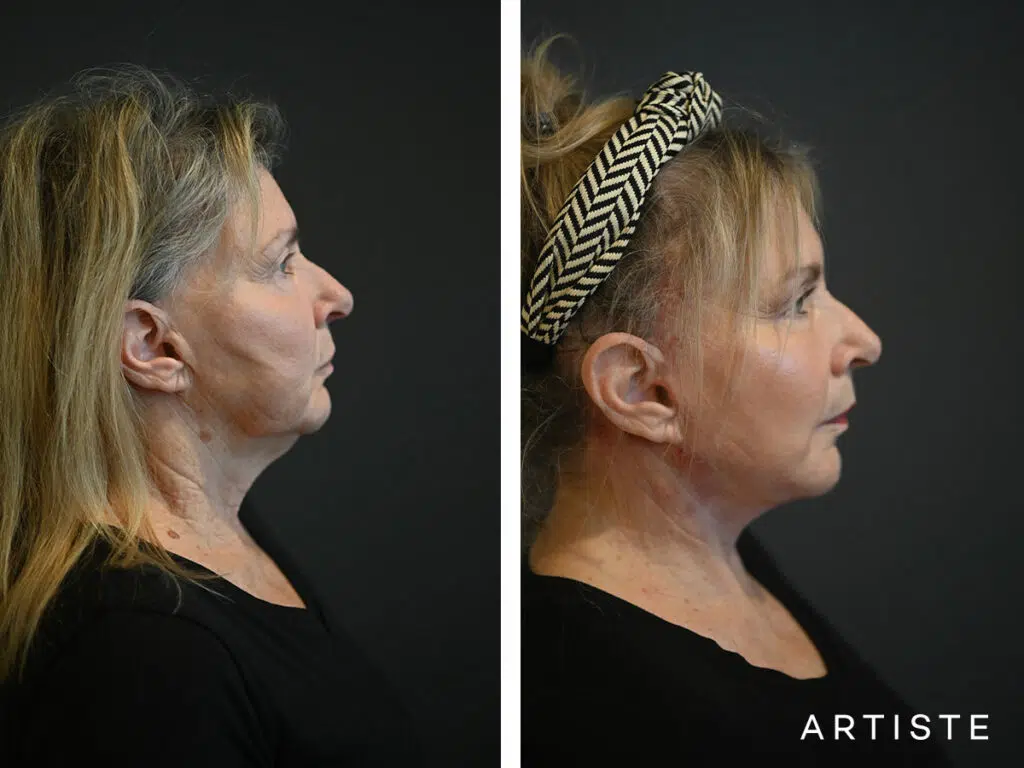 69 Years Old: Deep Plane Face and Neck Lift and Micro Fat Grafting