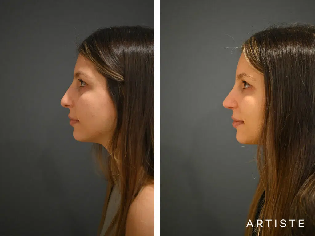 25 Years Old: 12 months Post Open Structure Rhinoplasty