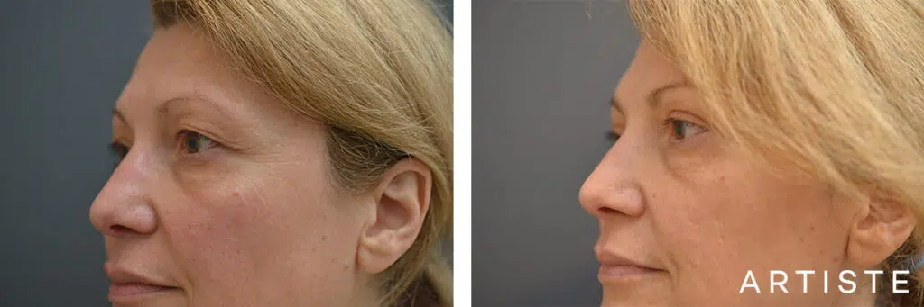 49 Years Old: Upper Eyelid Blepharoplasty