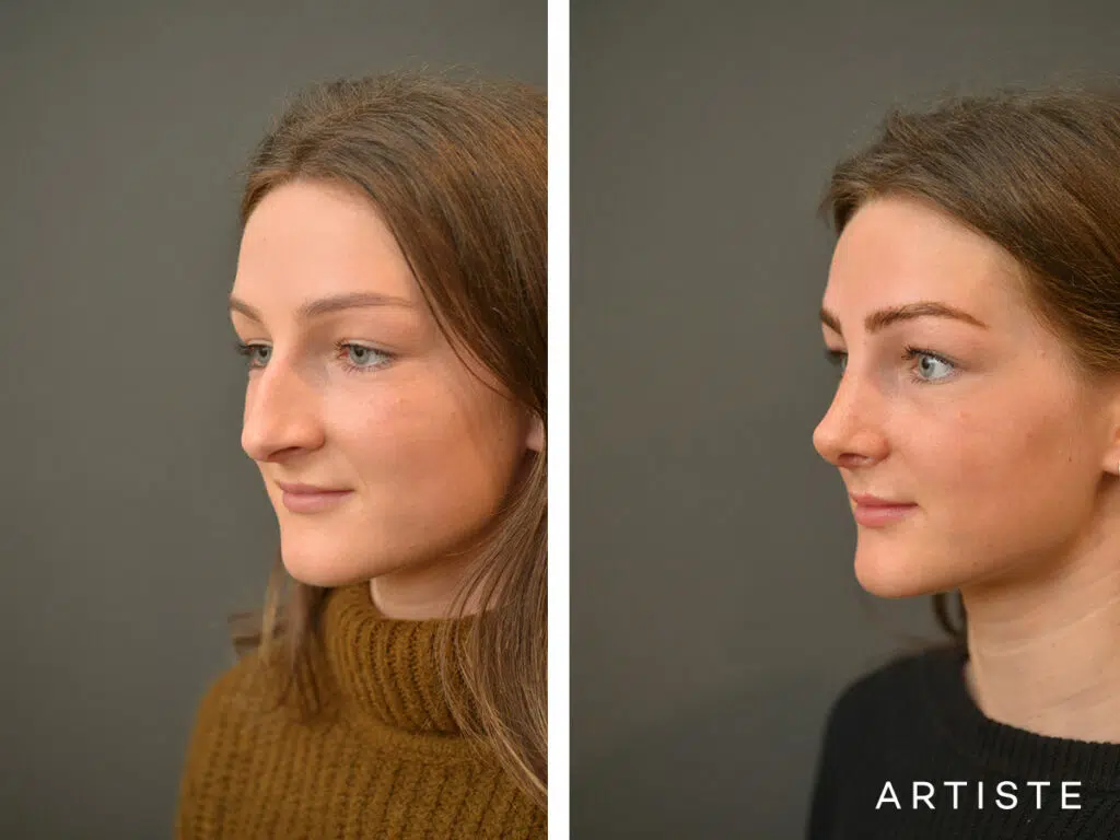 20 Years Old: 6 months Post Rhinoplasty