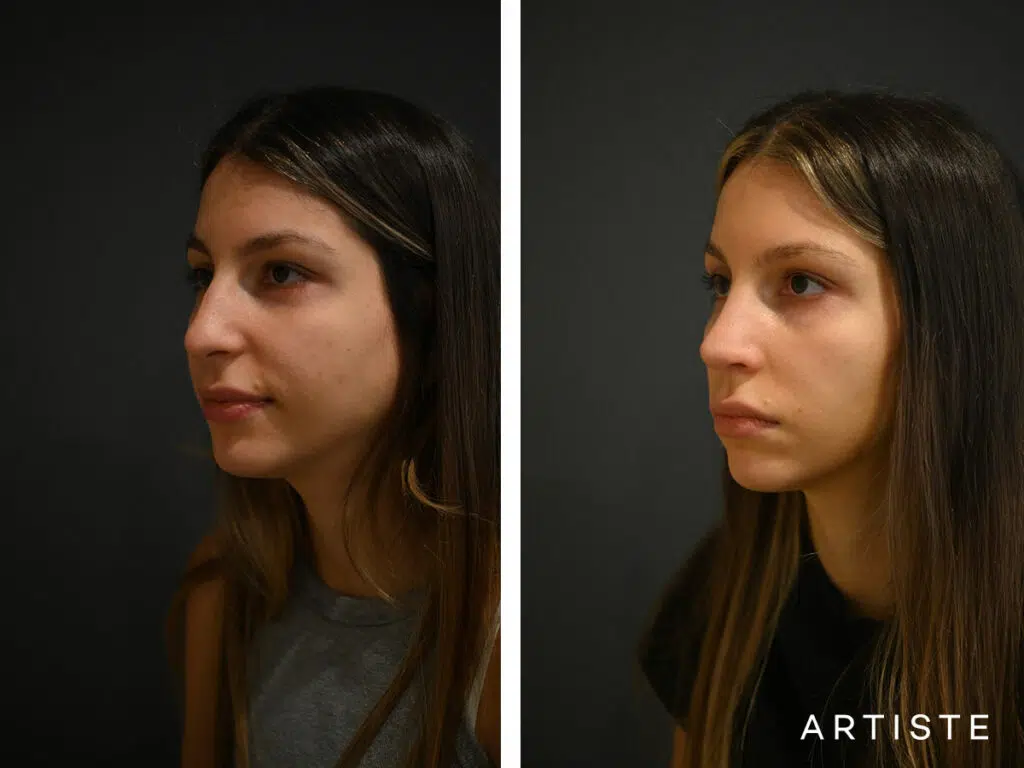 25 Years Old: 12 months Post Open Structure Rhinoplasty