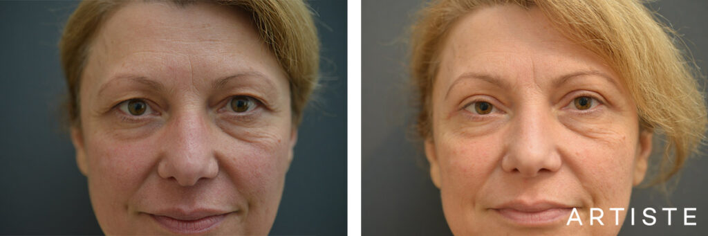 49 Years Old: Upper Eyelid Blepharoplasty