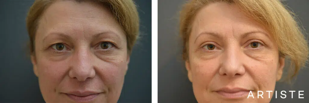 49 Years Old: Upper Eyelid Blepharoplasty